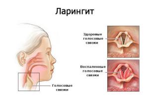 Фото Ларингит — отличия от других заболеваний горла, методы лечения