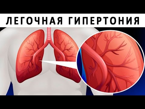 Видео о препарате Опсамит (Opsumit, Мацитентан) таб. 10мг №28