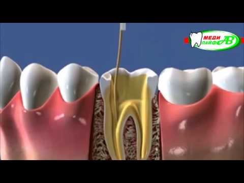 Видео о препарате Ледермикс паста стоматологическая туба 5г